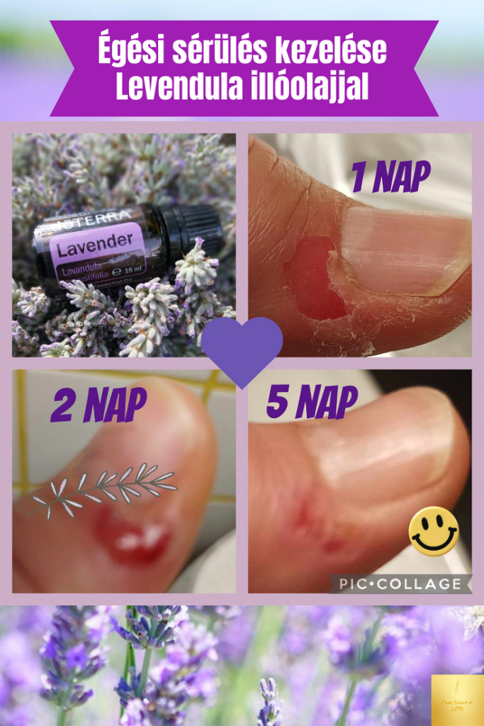 Égési sérülés kezelése levendula illóolajjal